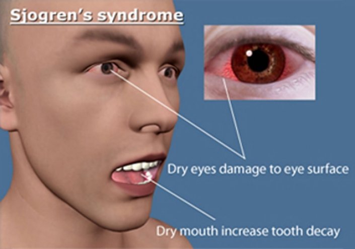 Sjogren’s Syndrome - Integrated Specialist Medical Care